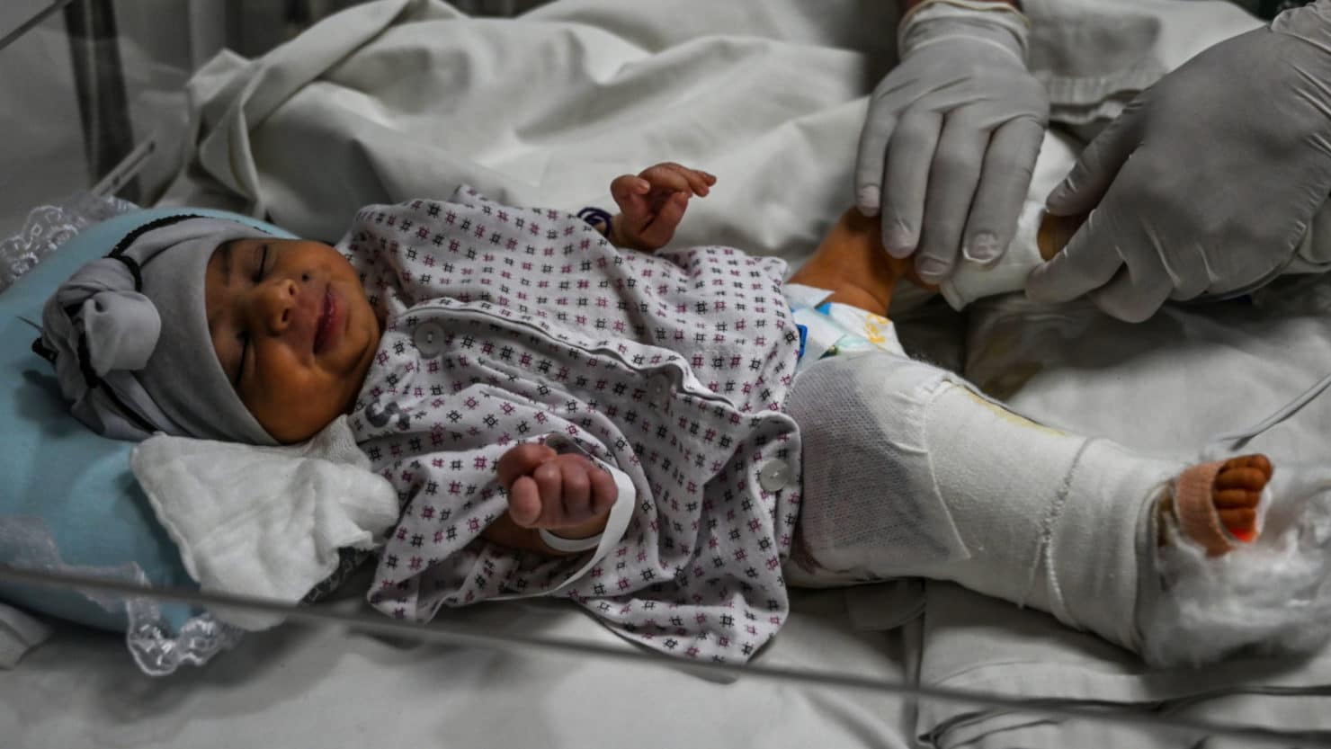 Afghan Doctors Cultivate a Grim Specialty: War Wounds in Babies – Undark
